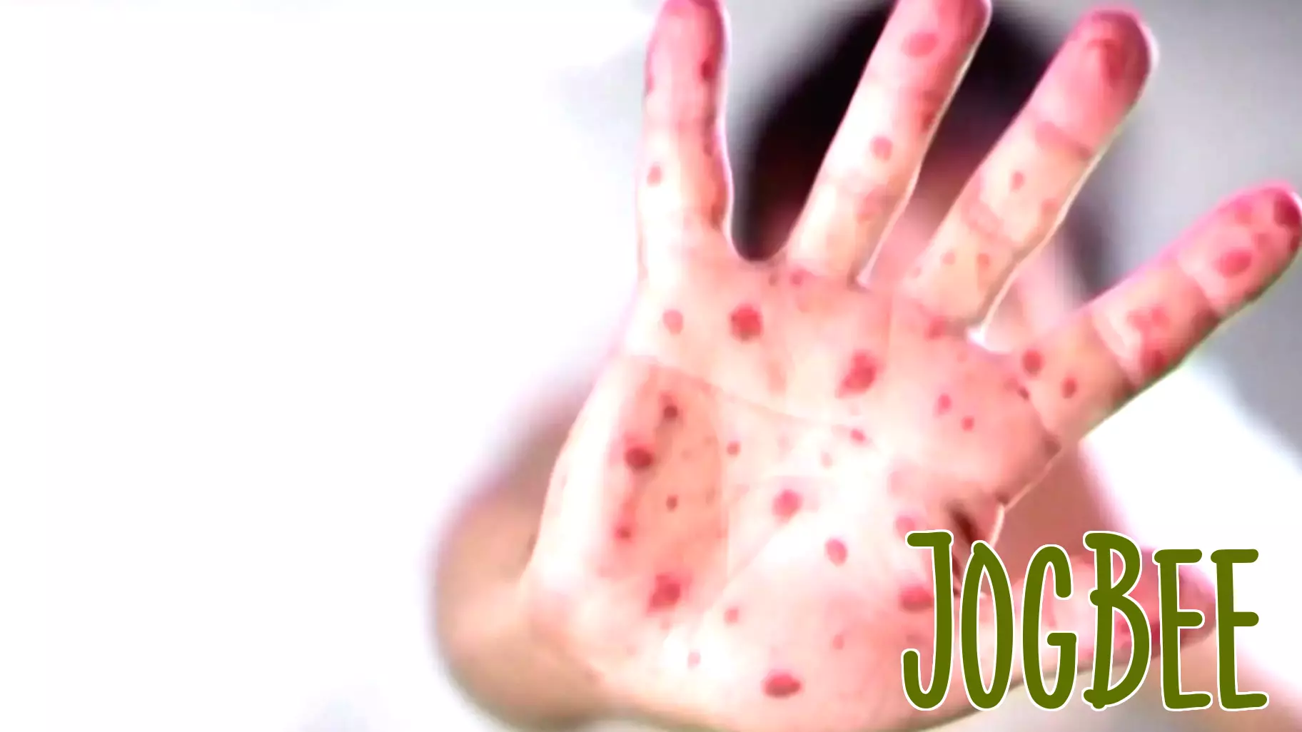 Chester County measles cases expected to increase as officials urge vaccination