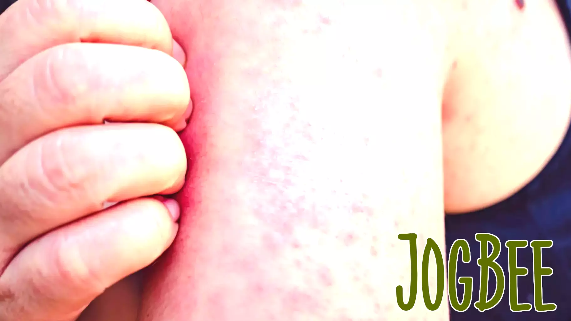 Five Confirmed Measles Cases Reported in Gallatin County, Montana