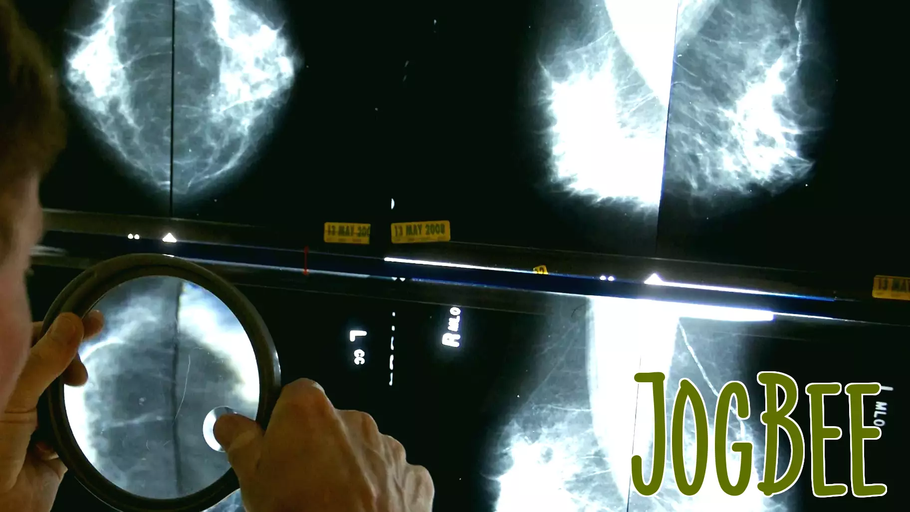 Penn study finds GLP-1 use associated with lower breast cancer risk; researchers to launch clinical trial