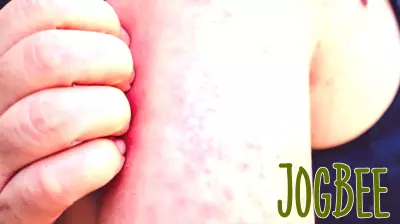 Five Confirmed Measles Cases Reported in Gallatin County, Montana